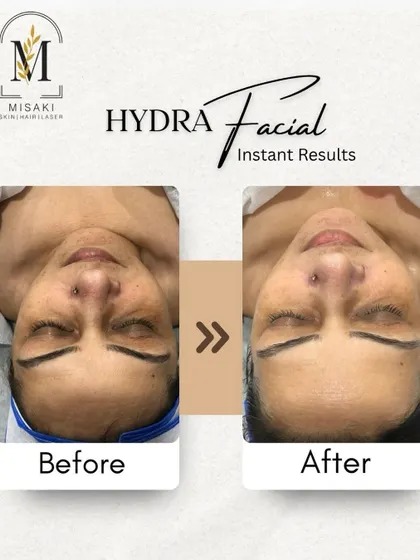 Another powerful before and after image demonstrating how a HydraFacial can transform dull, tired skin into a glowing, fresh complexion.