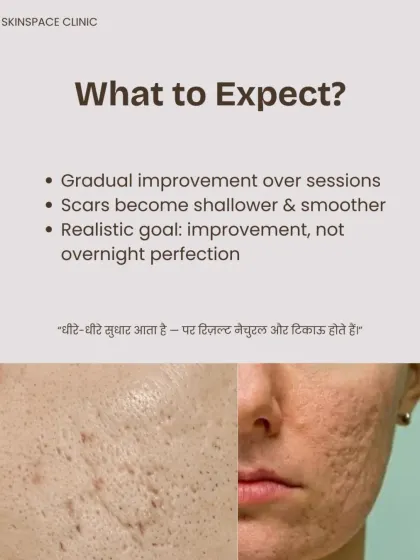 It is important to have realistic expectations. Improvement is gradual and happens over multiple sessions. The goal is to make scars shallower and smoother over time, leading to natural and lasting improvement, not overnight perfection.