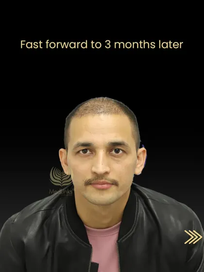 Three months after the procedure, Tika Ram's new hair is in the early growth phase.