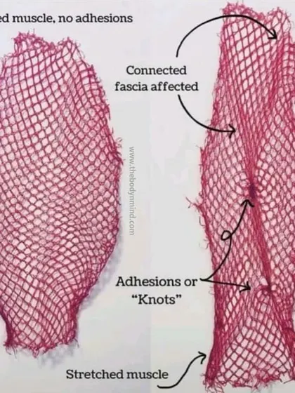 This image visually explains how fascial adhesions or "knots" form. Trauma and stress can cause the web-like fascial tissue to harden and restrict movement, leading to pain and limited mobility. Myofascial release techniques help to soften these adhesions.