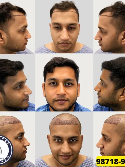 A complete 360-degree view of a patient's 8-month journey. We used 1550 grafts to restore his hairline, and these nine images show the process from every angle, before and after.