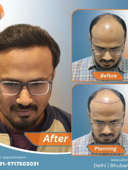 This series shows the meticulous planning phase with hairline marking, the before state, and the remarkable final result. It highlights the importance of a detailed approach to achieve a natural look.