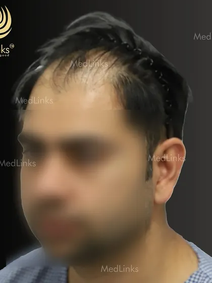 The side profile before the procedure.