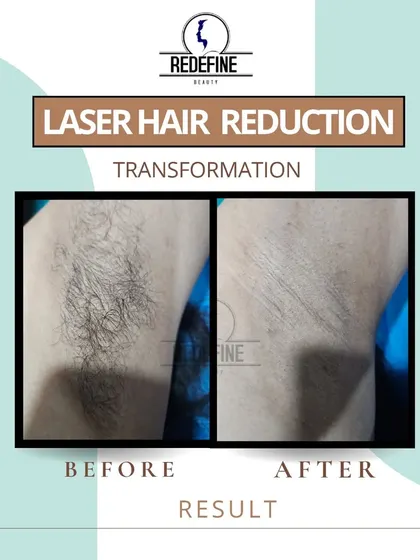 This before and after result for underarm hair removal is a common request. The treatment not only removes hair but can also help improve skin texture and reduce pigmentation caused by shaving.