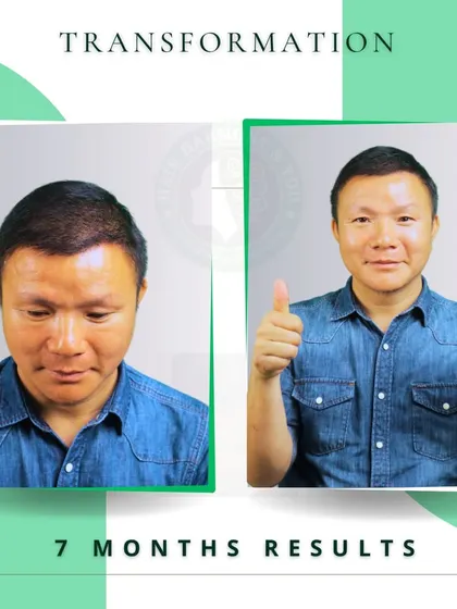 Seven months can make a world of difference. This client is proudly showing his progress, with a full head of hair that he can style with confidence. His satisfaction is my ultimate goal.