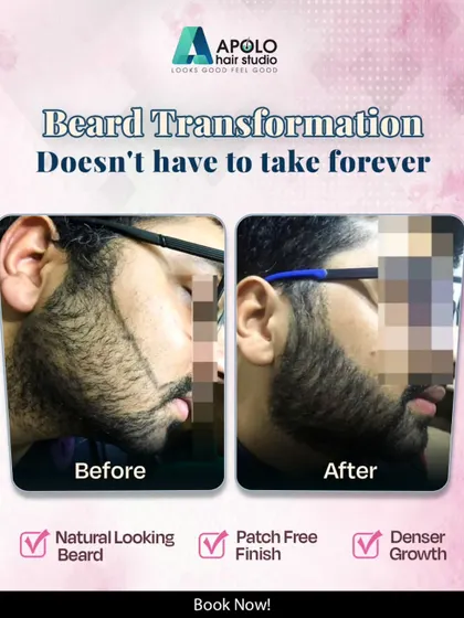 This before and after image shows the complete transformation possible with our beard transplant. We took this client from having uneven, patchy cheek growth to a full, natural looking beard with a defined shape and dense, even coverage.
