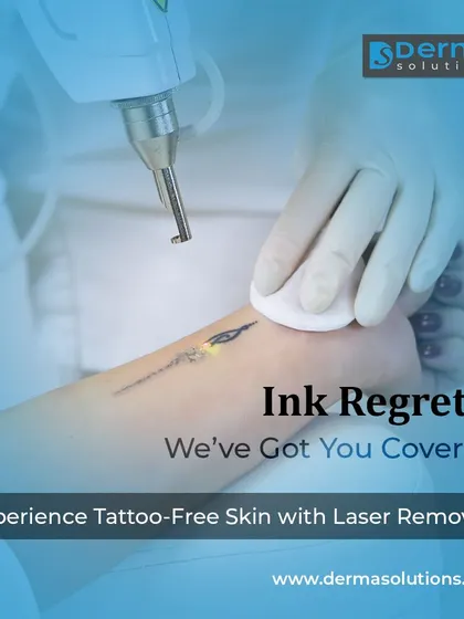 Whether your tattoo is large or small, the goal is a clean slate. Here, I am performing a laser removal procedure on a delicate tattoo on the foot. My approach ensures that only the ink is targeted, preserving the health of the surrounding skin.