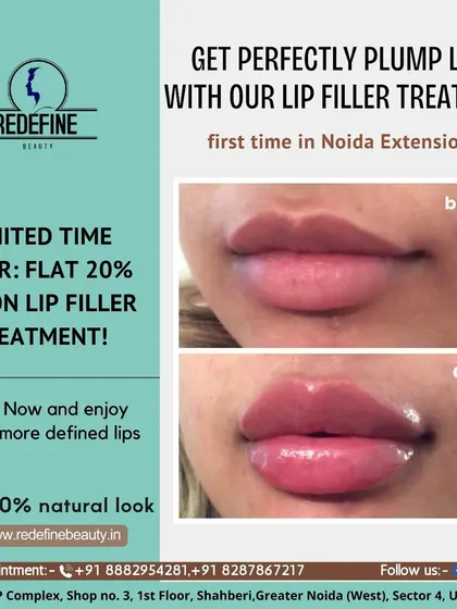 This is a great example of how lip fillers can create a fuller, more defined shape while still looking completely natural. I achieved this plump, hydrated look for a client who wanted to enhance her lips, and the results are immediate.