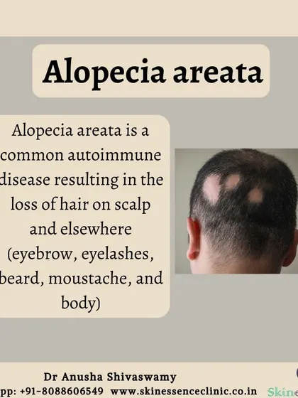 This graphic defines alopecia areata, an autoimmune condition where the body's immune system attacks hair follicles, resulting in distinct, often circular, patches of hair loss on the scalp or other parts of the body.