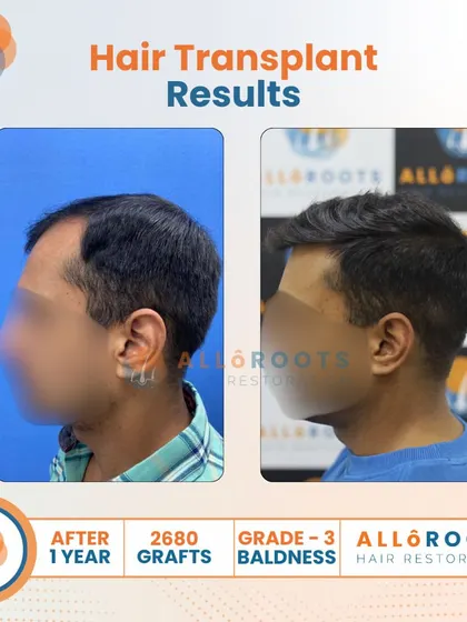 A one-year result for a Grade 3 baldness case using 2680 grafts. These images show the transformation from multiple angles, highlighting the restored density and the clean, natural hairline I designed.