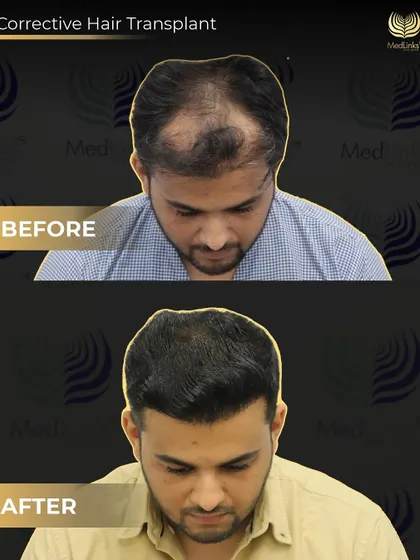 This top-down view shows the significant improvement in density and coverage after our corrective procedure. We specialize in these complex cases that require precision and experience.