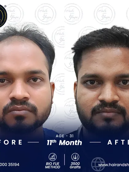 11 months after a 3500-graft BIO FUE transplant, this patient's result is fantastic. The new hair has grown in thick and healthy.