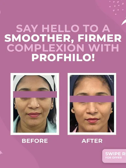 This before and after comparison shows the subtle yet impactful results of Profhilo. The treatment has visibly improved skin texture and firmness, providing a natural lift and a smoother, more radiant complexion.