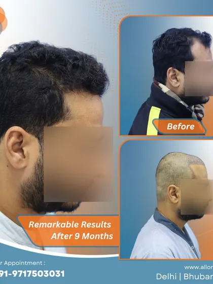 Remarkable results after just 9 months. This series shows the before, post-op, and after stages, highlighting the efficiency and effectiveness of the procedure.