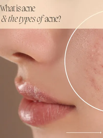 Understanding acne is the first step to treating it. This infographic provides a close-up look at how pores get clogged, leading to different types of acne.