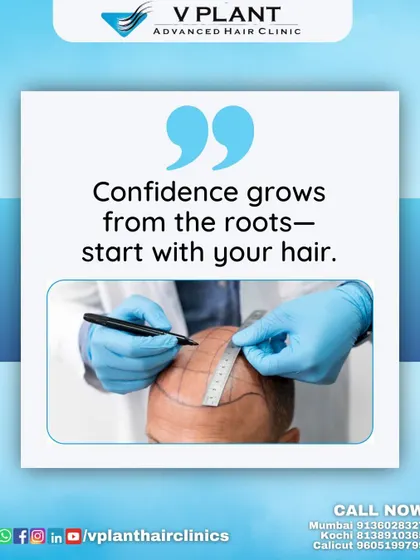 Confidence begins with precision. Here, you see a crucial step in our process: mapping the scalp for a hair transplant. This careful planning ensures that every graft is placed perfectly to create a natural hairline and achieve the density you desire. It’s not just about restoring hair, it’s about restoring you.