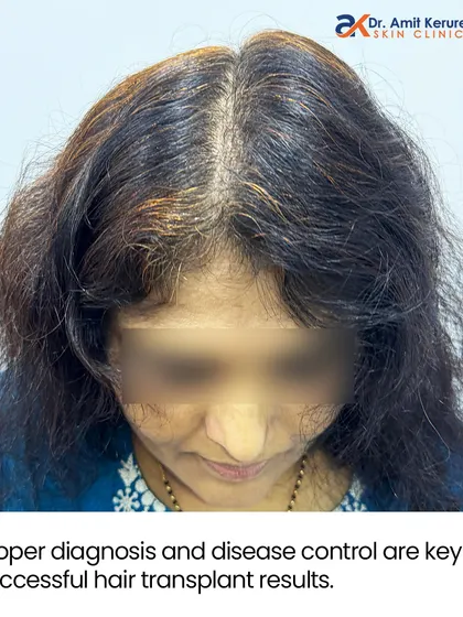 This 'after' image shows the same patient 12 months post-transplant. The key takeaway here is that proper diagnosis and controlling the disease first are essential for achieving such successful hair transplant results on a scarred scalp.