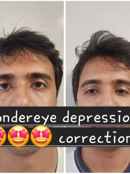 Anti-aging treatments are for everyone. This before and after demonstrates the correction of under-eye depression in a male client using fillers, effectively reducing the tired look and creating a smoother, more energized appearance.