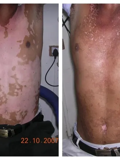 This image shows the kind of results we can achieve. With a consistent and correct treatment plan, it is possible to bring back your natural skin colour and manage Vitiligo effectively.
