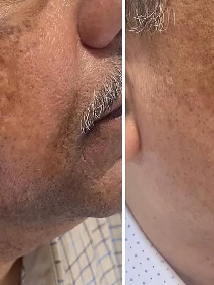 Addressing stubborn pigmentation requires a strategic approach. This result was achieved for a male patient using a combination of targeted in-clinic treatments and a dedicated skincare regimen designed to manage and reduce hyperpigmentation.