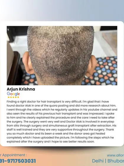 "The surgery went very well and Doctor Alok is involved in every step." Thank you, Arjun Krishna, for your detailed review. It is my principle to be directly involved in the critical steps of every surgery to ensure the best outcome.