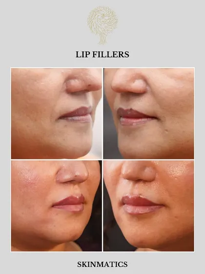 Lip enhancement is about achieving balance and proportion, not just size. Here, we used lip fillers to add subtle volume and definition, resulting in a naturally fuller and more hydrated look.