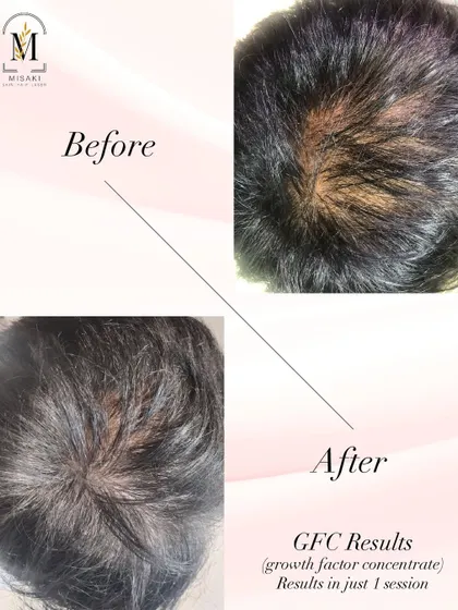 The results speak for themselves. This client achieved significant hair regrowth and improved thickness after just one session of Growth Factor Concentrate (GFC) therapy. My goal is to help you get your confidence back with visible results.