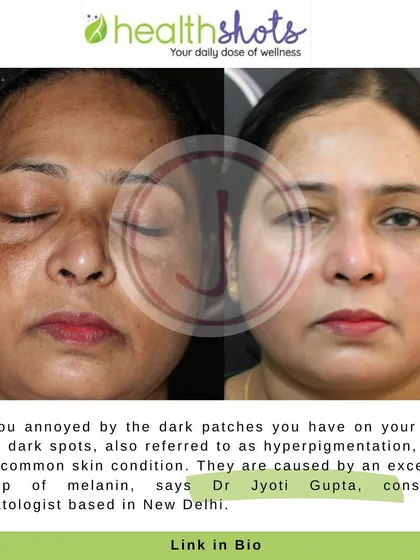 In this feature for Healthshots, I discuss the causes of hyperpigmentation, or dark patches, which result from excess melanin. Professional guidance is key to treating this common skin condition effectively.