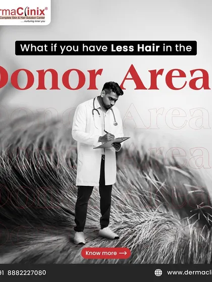 Worried about a limited donor area? We have advanced techniques that can help. This post introduces the concept of using body hair for restoration.