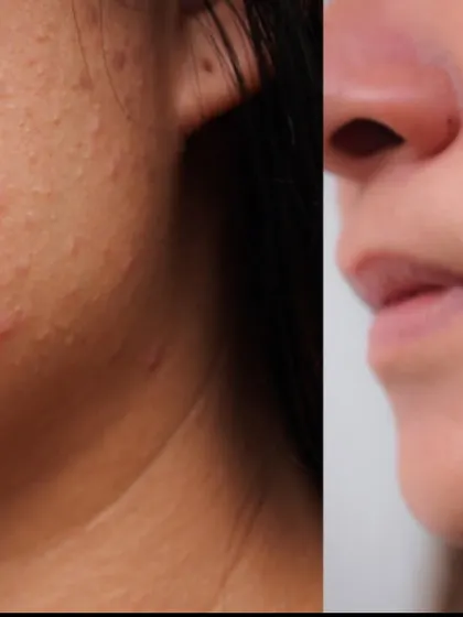 From active, painful breakouts to calm, healing skin. This result was achieved by first controlling the underlying inflammation with medical treatment, which is the essential first step before any scar revision can begin.
