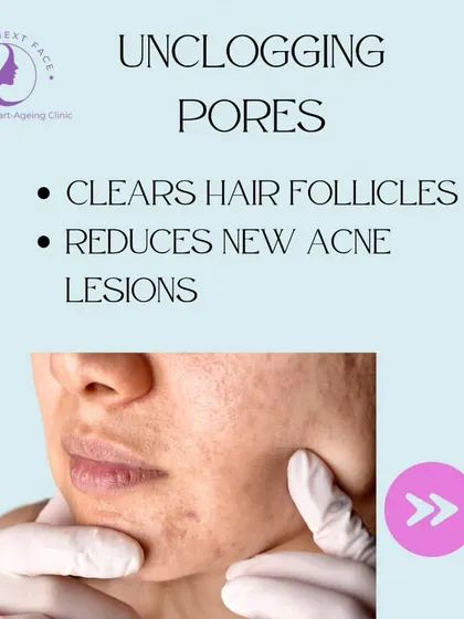 Benefit 2 of Peels for Acne: Unclogging Pores. By clearing out hair follicles, peels help reduce the formation of new acne lesions.
