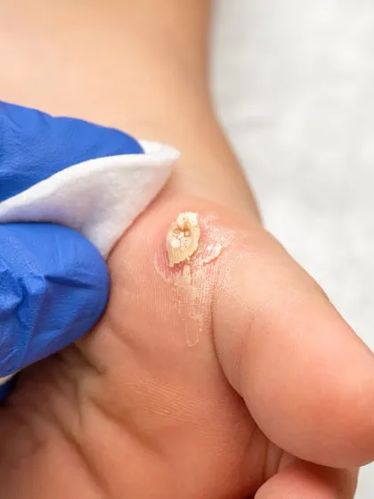 This image shows a common wart on the foot, which can be painful and stubborn. I use effective treatments like cryotherapy or RF cautery to completely remove the wart and destroy the underlying virus, preventing it from spreading or recurring.