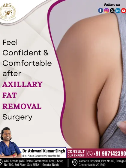 The small bulge of fat in the underarm area, known as axillary fat, can be a concern for many. I perform axillary fat removal to create a smoother, more streamlined contour between the breast and arm, helping you feel more confident in sleeveless clothing.