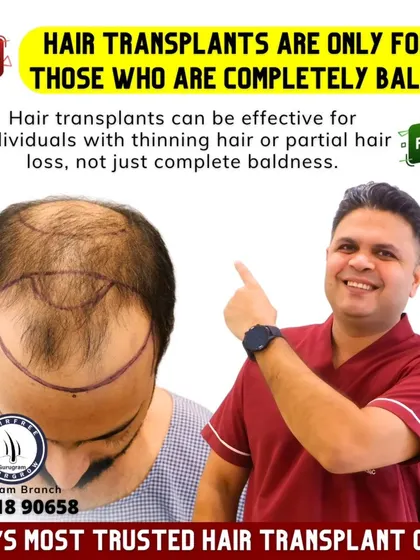 **Myth:** Hair transplants are only for those who are completely bald. **Fact:** Not at all. Transplants are very effective for individuals with thinning hair or partial hair loss to restore density and redefine the hairline.