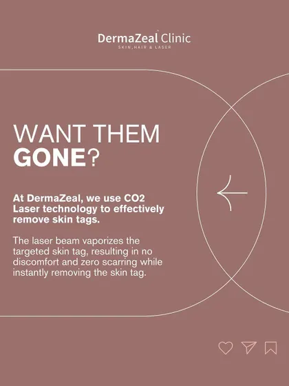 Want them gone? At my clinic, I use CO2 Laser technology to effectively remove skin tags. The laser beam vaporizes the tag instantly with no discomfort and zero scarring.