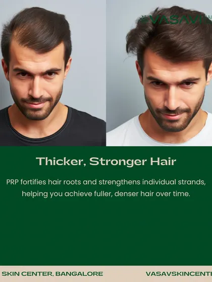The goal of PRP therapy is to achieve thicker, stronger hair. The treatment fortifies hair roots and strengthens individual strands, leading to fuller and denser hair over the course of several sessions.