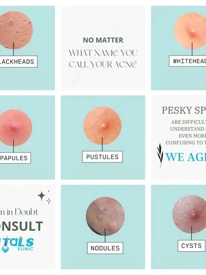 No matter what you call it, from a simple pimple to a painful cyst, acne can be confusing to treat. When in doubt, a professional consultation is the best way to get a correct diagnosis and an effective plan.