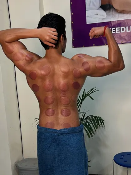 Another angle of Sumit's back post-cupping.