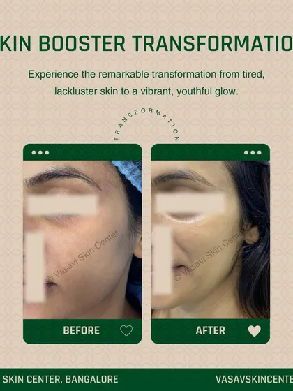 This before and after image shows the transformative effect of a Skin Booster treatment. You can see a significant improvement in skin radiance and texture, moving from a tired appearance to a vibrant, hydrated glow.