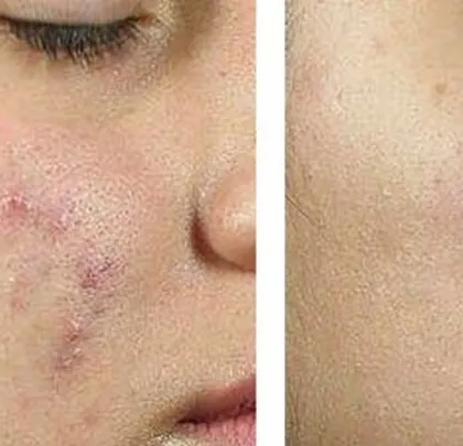 This transformation shows a significant reduction in both acne marks and textural irregularities. A combination of chemical peels and laser toning helped to fade the pigmentation and smooth the skin for a clearer complexion.