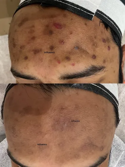 Notice the significant fading of dark spots and acne marks on the forehead. This result was achieved through a customized plan targeting hyperpigmentation.