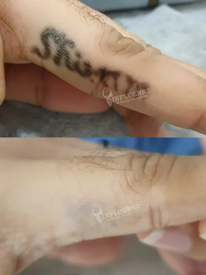 This before and after shows the removal of a name tattoo from a finger. Even on delicate areas, the Pico laser can be used safely to achieve clear results.