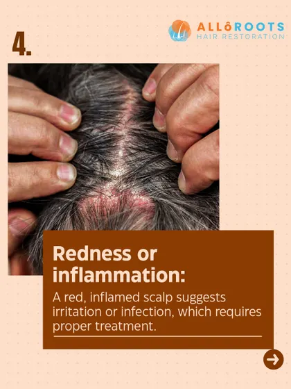A red, inflamed scalp is a clear sign of irritation or a potential infection. This requires proper medical treatment to calm the inflammation and prevent damage to the hair follicles.