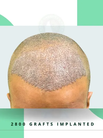 This image shows 2800 grafts implanted to restore the frontal hairline and mid-scalp. The density is excellent and promises a fantastic result once the hair grows in.