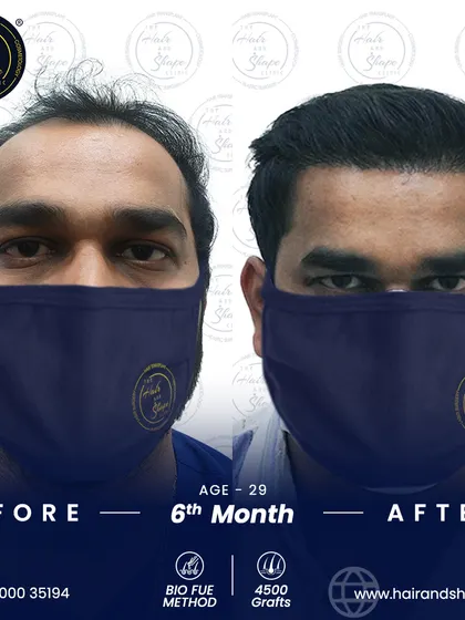 Just 6 months after a 4500-graft BIO FUE transplant, this patient's transformation is already remarkable, with a restored hairline and fuller look.