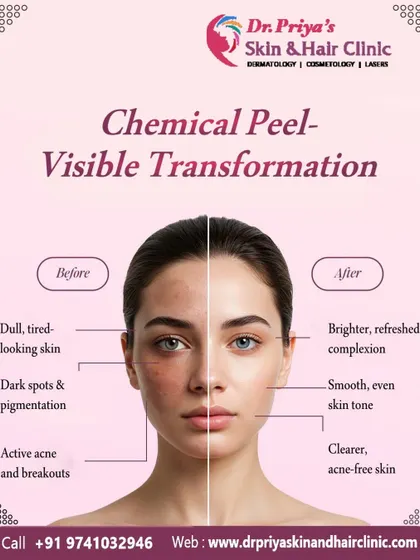 This image demonstrates the visible transformation possible with a chemical peel. The treatment effectively addresses dullness, dark spots, and active acne by exfoliating the skin's surface, revealing a brighter, clearer, and more even-toned complexion.