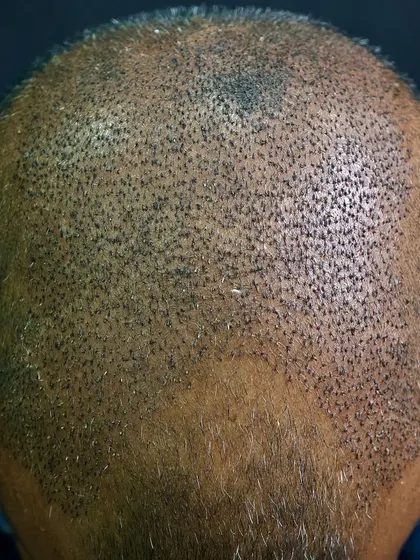 This is the result six months after a 3500-graft FUE transplant. The hair has grown in, covering the previously bald area and creating a full, natural look.