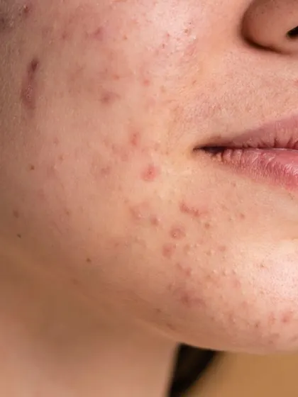 Dealing with both active acne and the scars it leaves behind requires a dual approach. I first focus on controlling the breakouts with medical therapy, then move on to scar revision treatments like microneedling or lasers to repair the skin's texture.