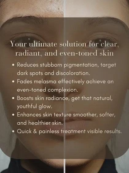 This before-and-after comparison shows the effectiveness of the Q-Switched ND YAG Laser. It is my ultimate solution for reducing stubborn pigmentation, fading melasma, and boosting skin radiance for a smoother, healthier, and more even-toned complexion.
