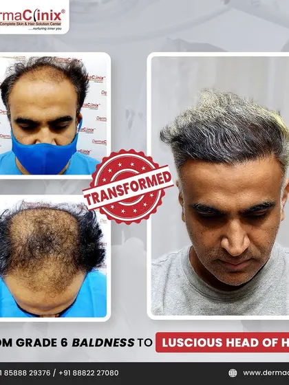 From Grade 6 baldness to a luscious head of hair. This collage shows the dramatic before and after of Mr. Dhiraj, proving that even advanced hair loss can be successfully treated.